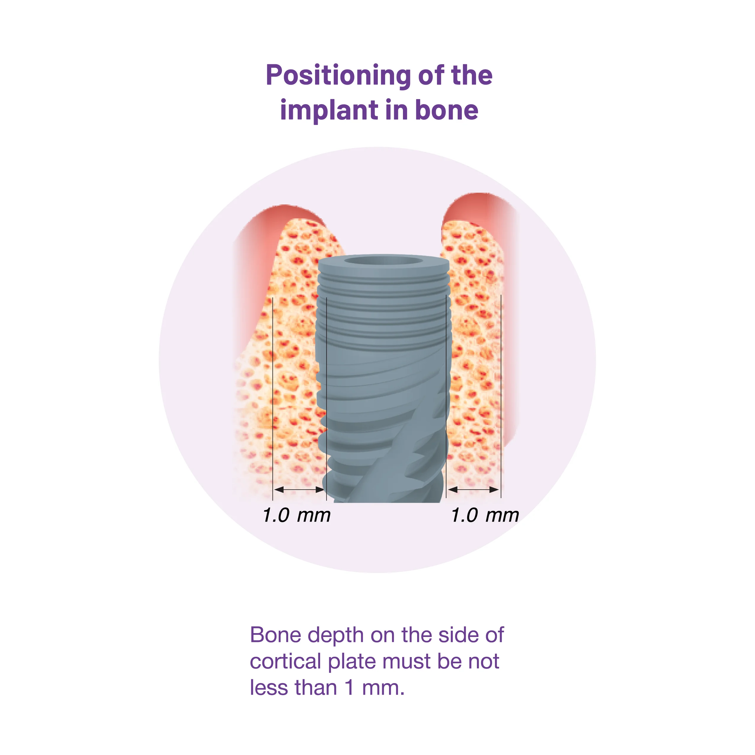 Positioning of the implant in bone