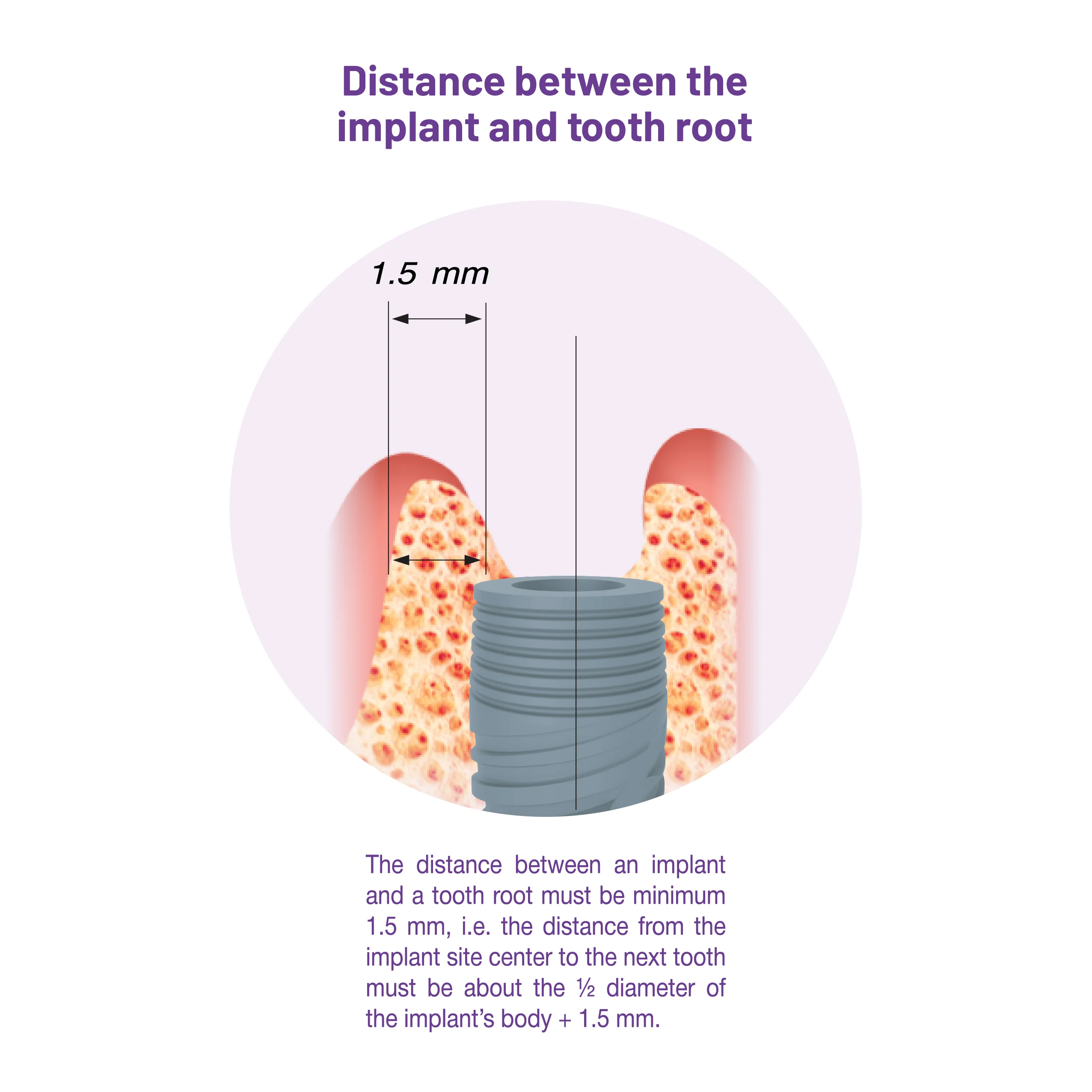 Distance between the implant and tooth root