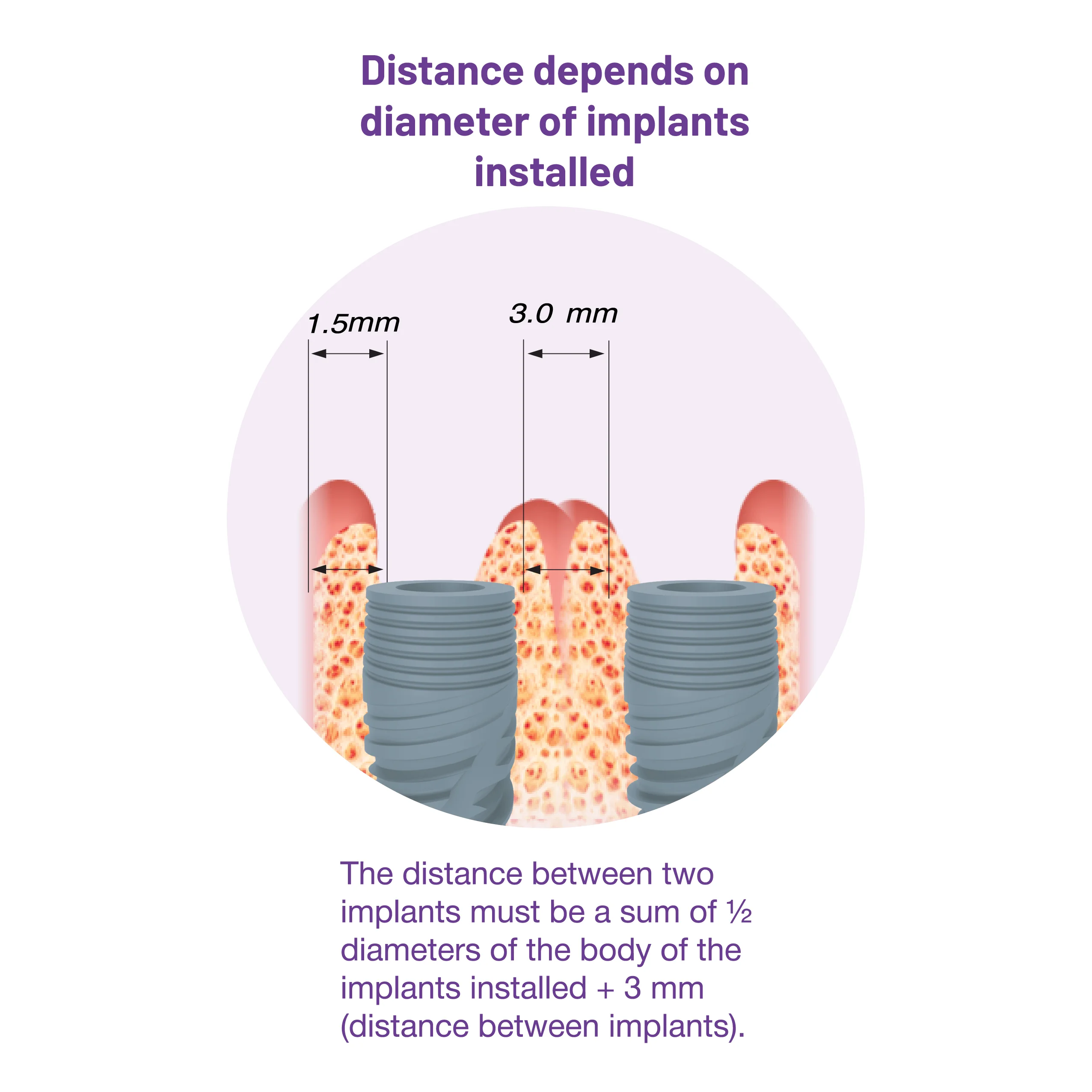 Distance depends on diameter of implants installed