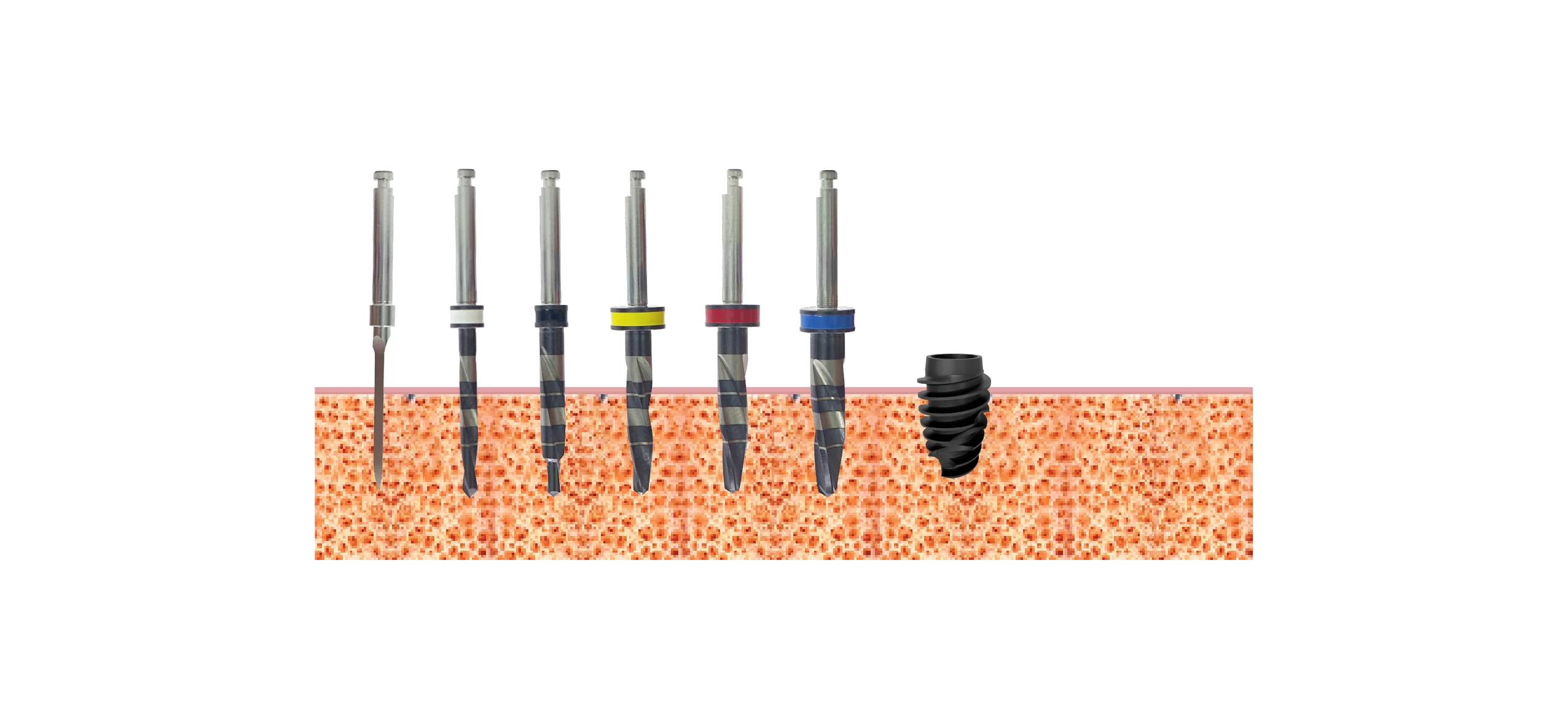 Drill sequence, implants 4.0mm, Bone type I, II