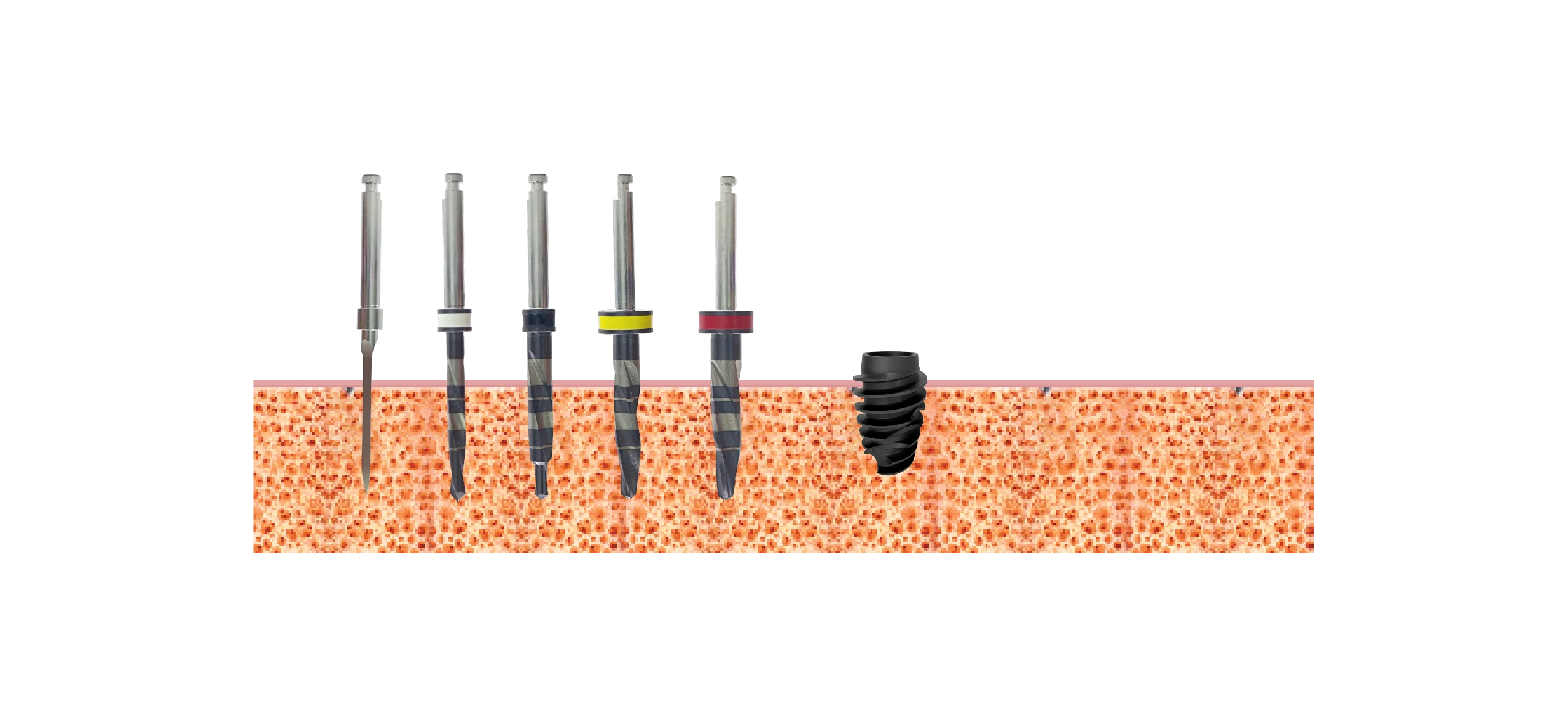 Drill sequence, implants 4.0mm, Bone type III