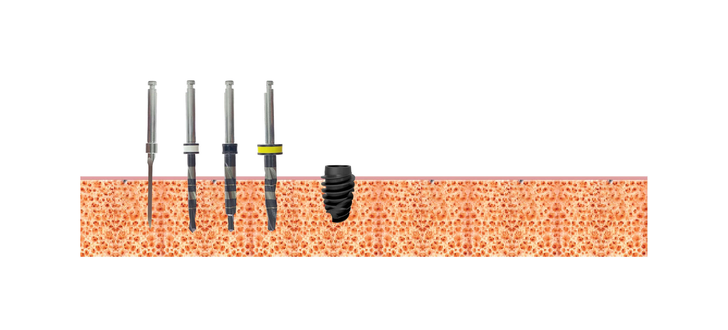 Drill sequence, implants 4.0mm, Bone type IV