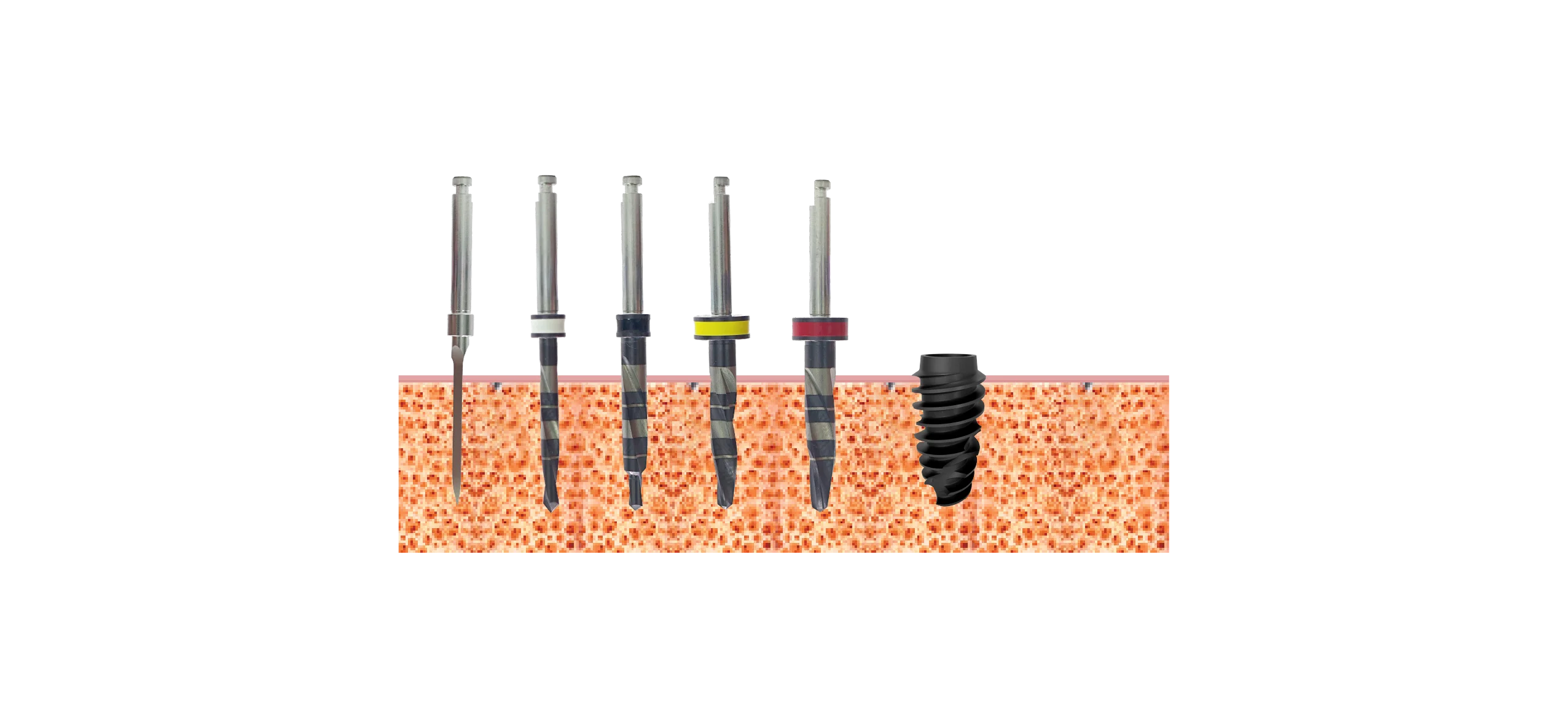 Drill sequence, implants 4.5mm, Bone type III, IV